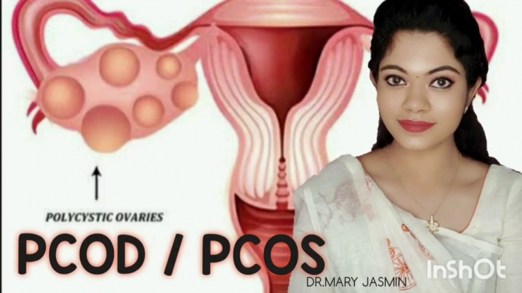 POLYCYSTIC OVARIAN SYNDROME | DR.MARY JASMIN