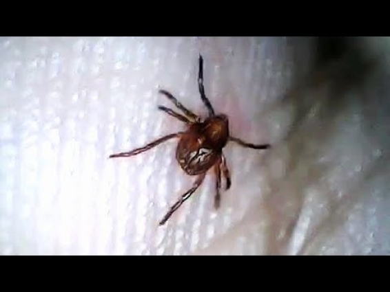Remove Ticks from humans – My daughter was bitten by a ticks